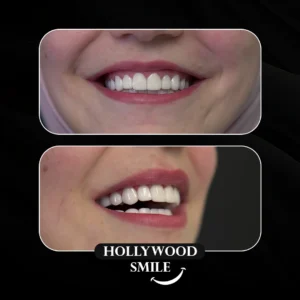 Hollywood Smile in Istanbul